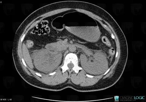 Forniceal rupture, Collecting system, CT