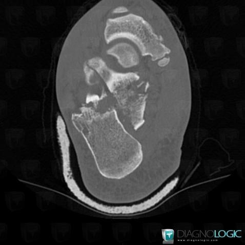 Fracture, Calcaneus, CT