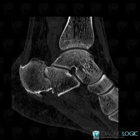 Fracture, Calcaneus, CT