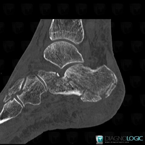 Fracture, Calcanéus, Radio