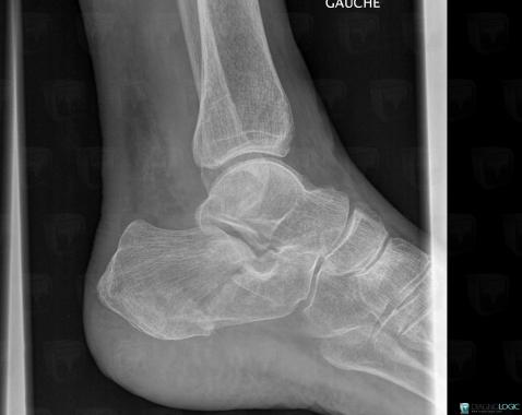 Fracture, Calcaneus, X rays