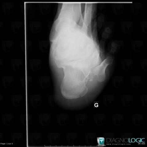 Fracture, Calcaneus, X rays