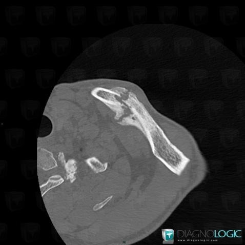 Fracture, Clavicle, CT