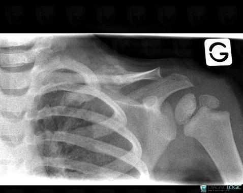 Radiology Case : Fracture (X Rays) - Diagnologic