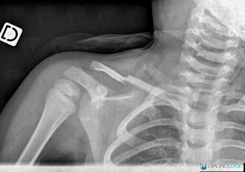 Fracture, Clavicle, X rays