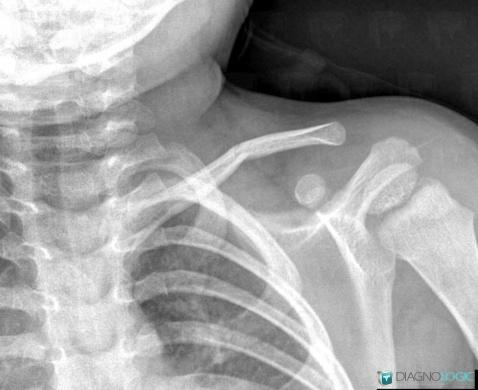 Fracture, Clavicle, X rays