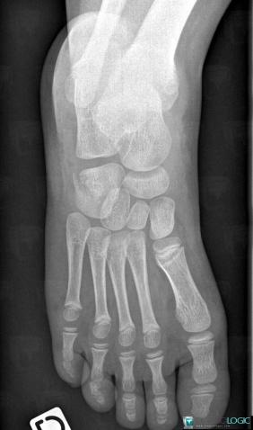 Fracture, Cuboid, X rays