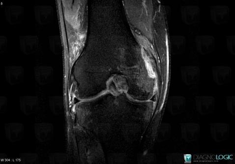 Fracture, Femur - Distal part, MRI