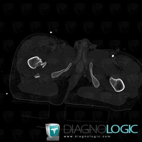 Fracture, Femur - Proximal part, CT