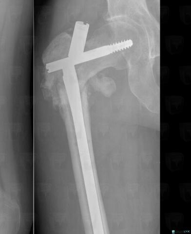 Fracture, Femur - Proximal part, X rays