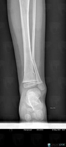 Fracture, Fibula - Distal part, X rays