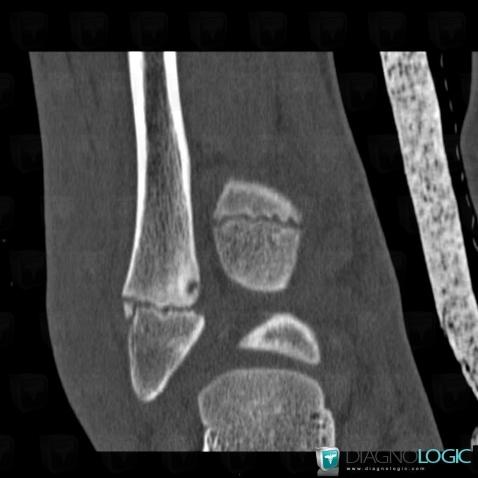 Fracture, Fibula -inférieur, Scanner