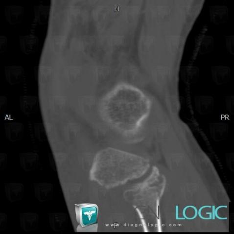 Fracture, Fibula - Proximal part, CT