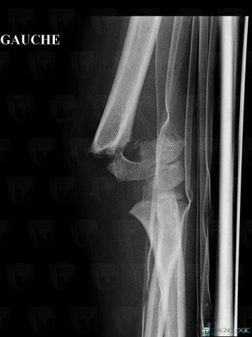 Fracture, Humerus - Distal part, X rays