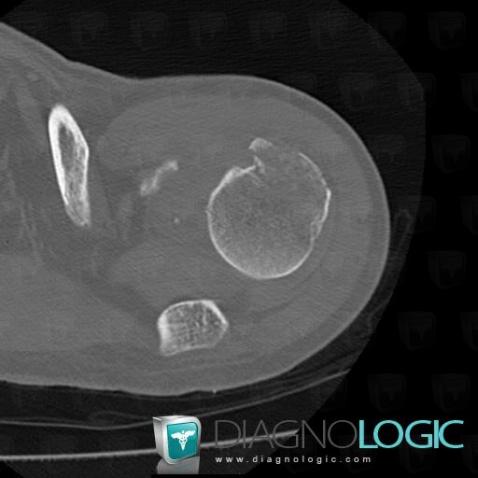 Fracture, Humerus - Proximal part, CT