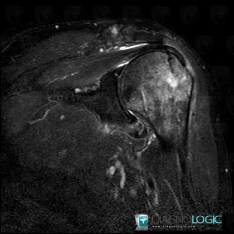 Fracture, Humerus - Proximal part, MRI