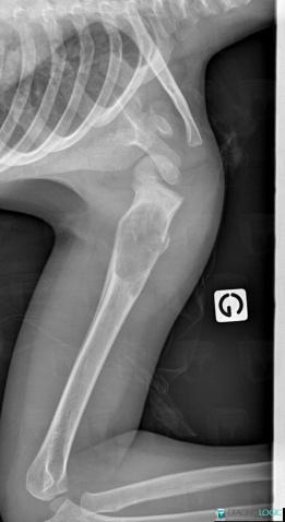 Fracture, Humérus -supérieur, Radio