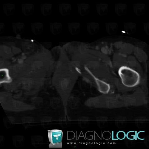 Fracture, Ilium, CT