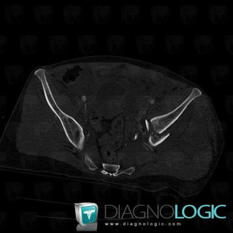 Fracture, Ilium, CT
