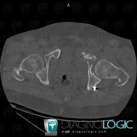 Fracture, Ilium, CT