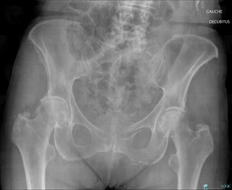 Fracture, Ilium, X rays