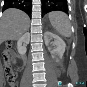 Fracture, Kidney, CT