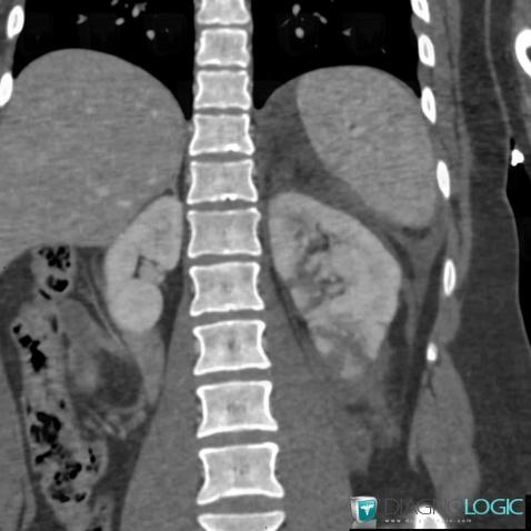 Fracture, Kidney, CT