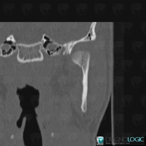 Fracture, Mandible, CT