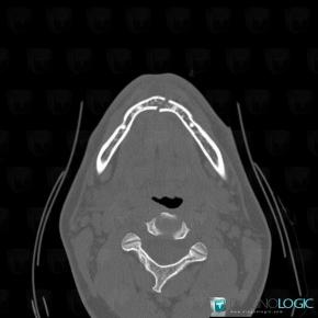 Fracture, Mandible, CT