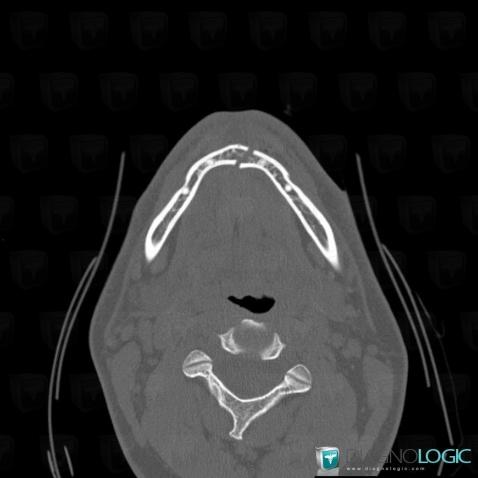 Fracture, Mandible, CT