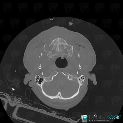 Fracture, Maxilla, CT