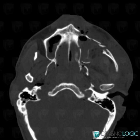 Fracture, Maxillaire, Scanner