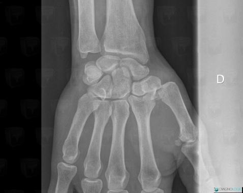 Radiology Case : Fracture (X Rays ,CT) - Diagnologic