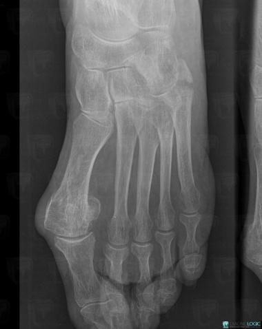 Fracture, Metatarsal bones, X rays