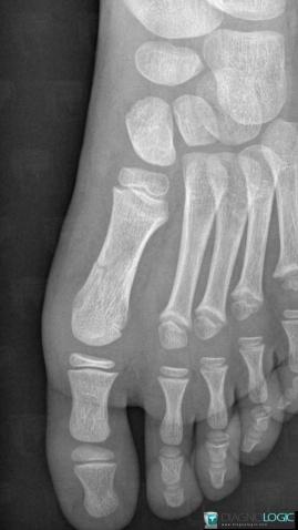 Fracture, Metatarsal bones, X rays