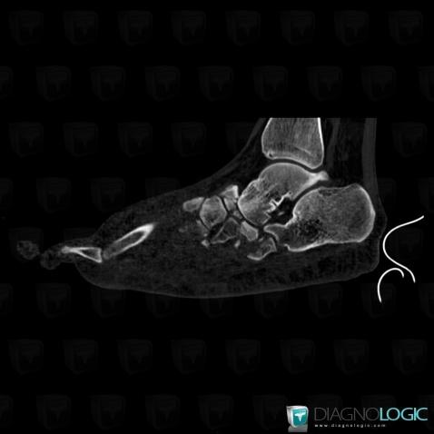 Fracture, Navicular, CT