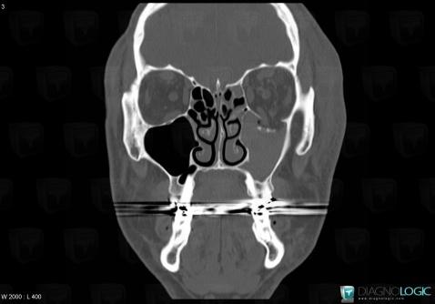 Fracture, Orbital bones, CT