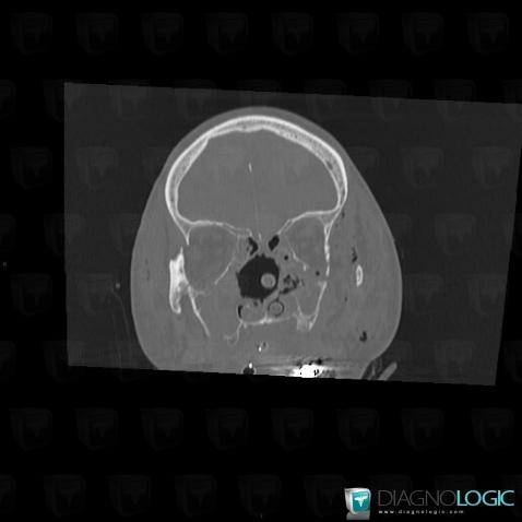 Fracture, Orbital bones, CT