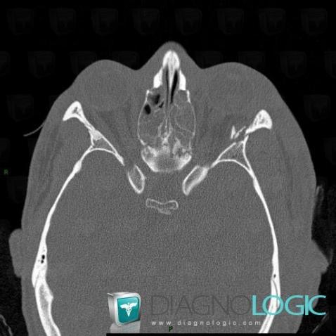 Fracture, Os-l orbite, Scanner