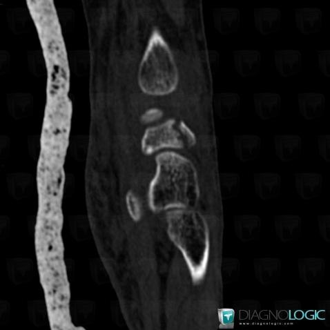 Fracture, Other carpal bones, CT