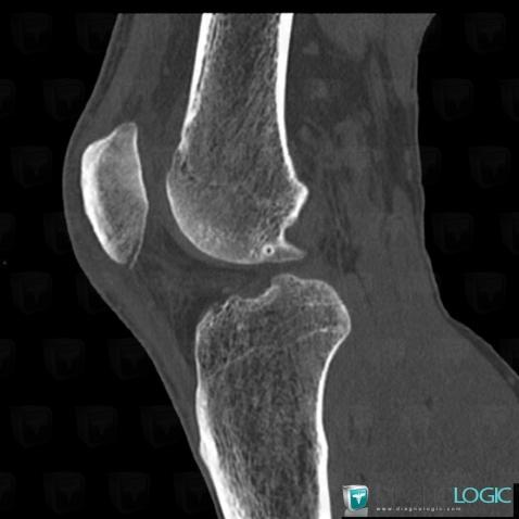 Fracture, Patella, CT