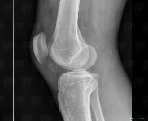 Fracture, Patella, X rays