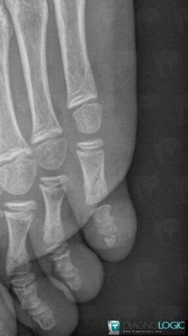 Fracture, Phalanx / Sesamoid bones - Foot, X rays