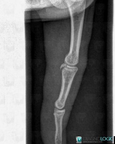 Fracture, Phalanx / Sesamoid bones - Hand, X rays