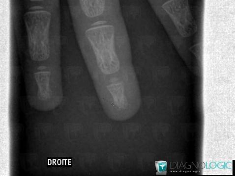 Fracture, Phalanx / Sesamoid bones - Hand, X rays