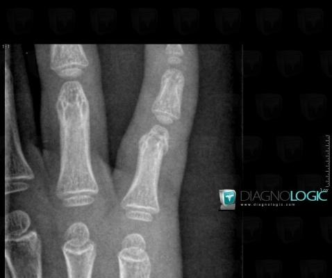 Fracture, Phalanx / Sesamoid bones - Hand, X rays