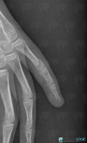 Fracture, Phalanx / Sesamoid bones - Hand, X rays