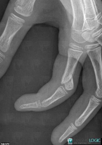 Fracture, Phalanx / Sesamoid bones - Hand, X rays