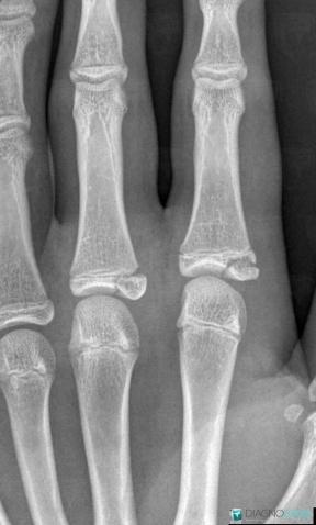 Fracture, Phalanx / Sesamoid bones - Hand, X rays