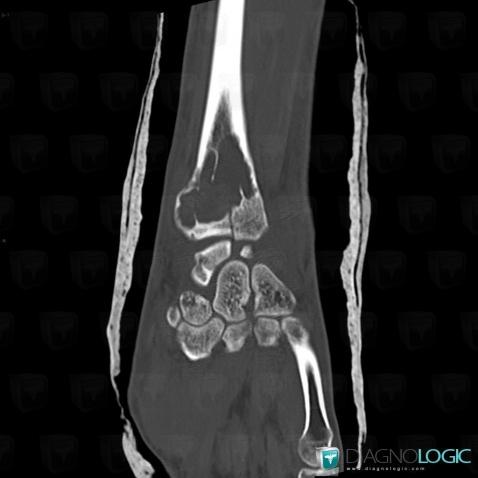 Fracture, Radius - Distal part, CT